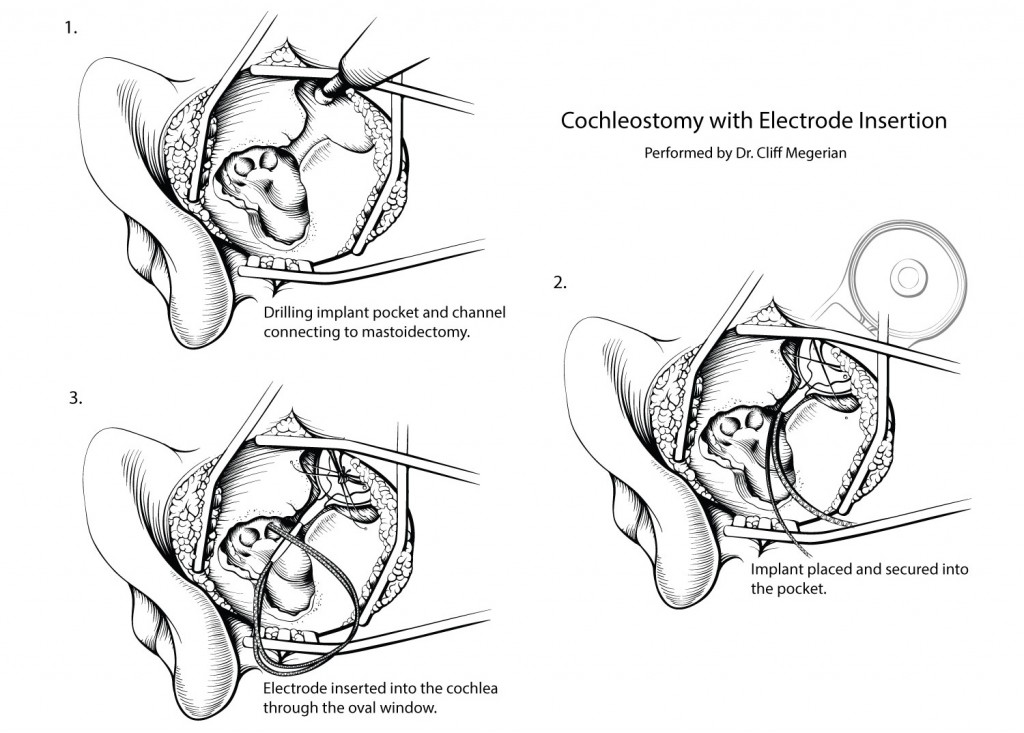 Line art showing a cochleostomy with electrode insertion in three steps.