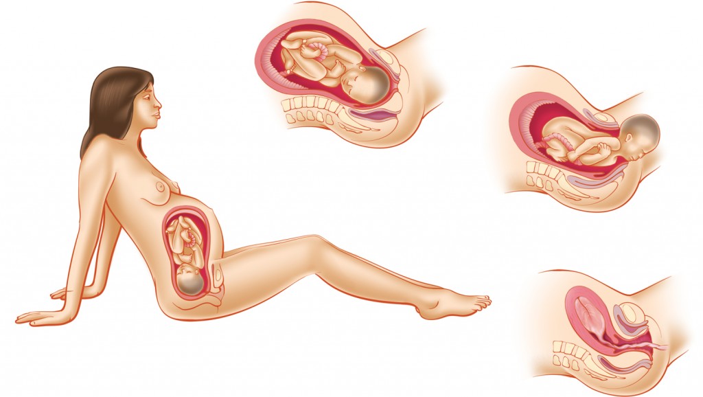 Color illustration of a woman giving birth. Large view of woman, and three inset views showing birth process.