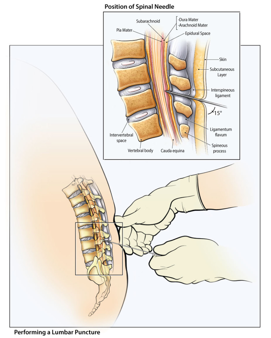 Color illustration showing the correct positioning for performing a lumbar puncture. Also shows a cut-away of the needle passing through tissue layers.